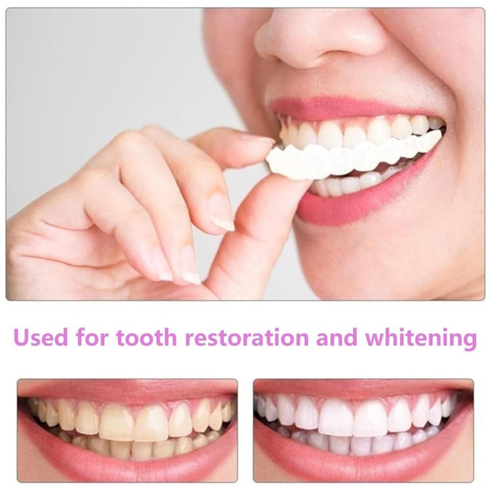 Tandenprotheses voor boven- en - Teeth Whitening For Braces recensie en prijs