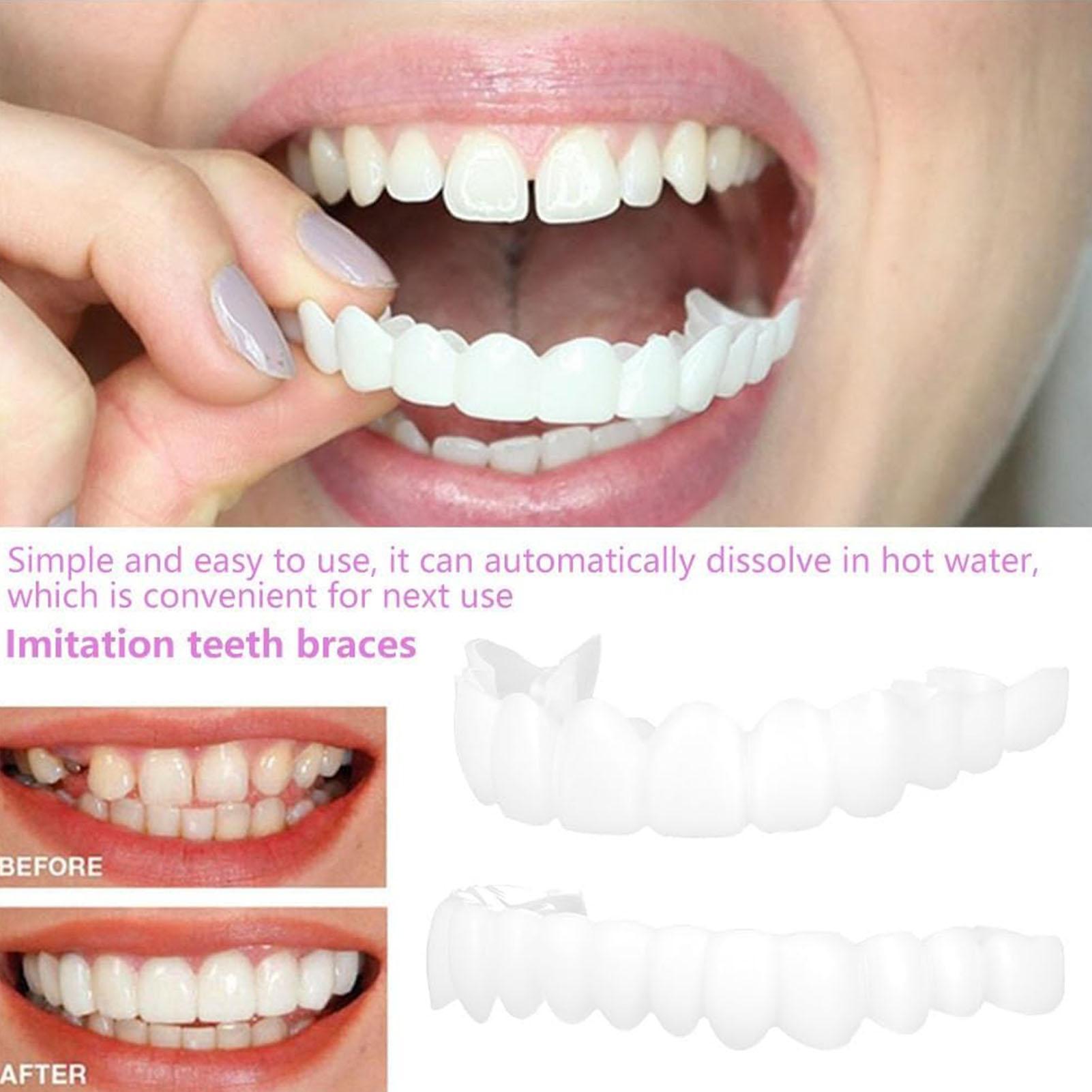 Tandenprotheses voor boven- en - Teeth Whitening For Braces recensie en prijs