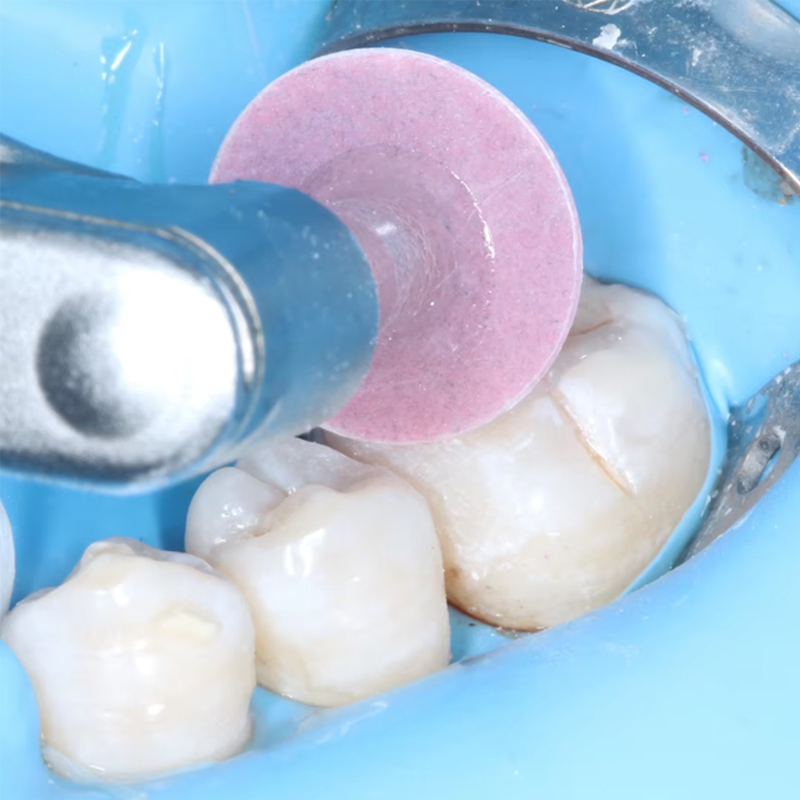 40 Stuks Tandheelkundige Polij - Teeth Whitening Professional recensie en prijs