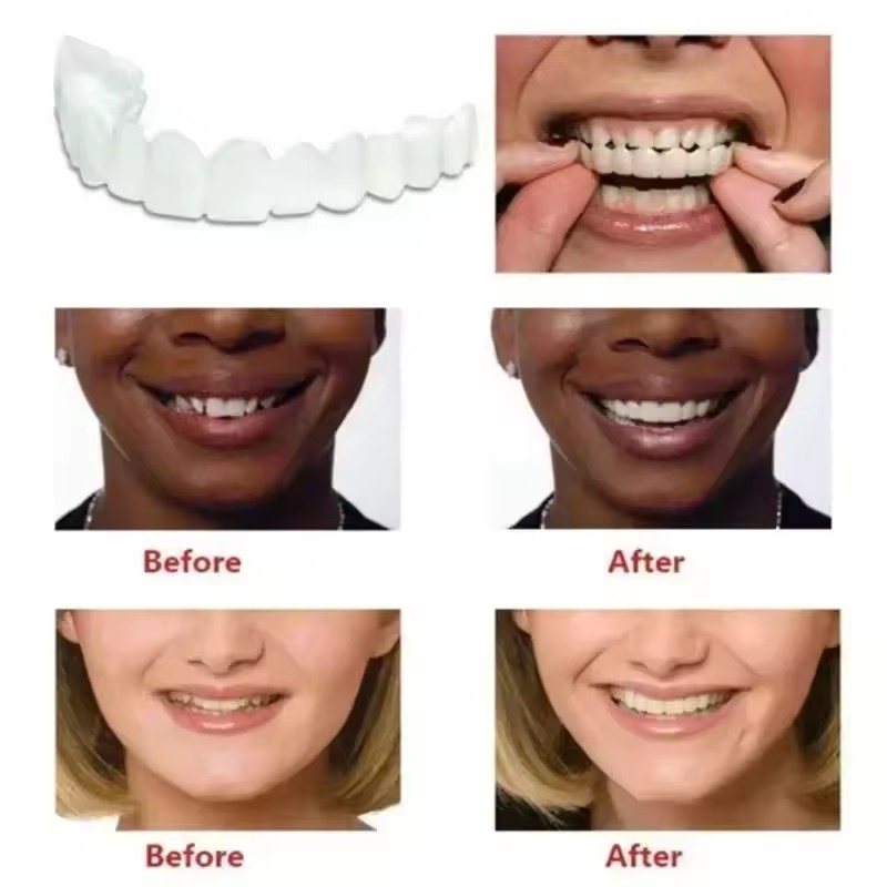 Tanden Veneers Bleekmiddelen P - Teeth Whitening For Braces recensie en prijs