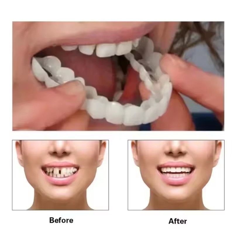 Tanden Veneers Bleekmiddelen P - Teeth Whitening For Braces recensie en prijs
