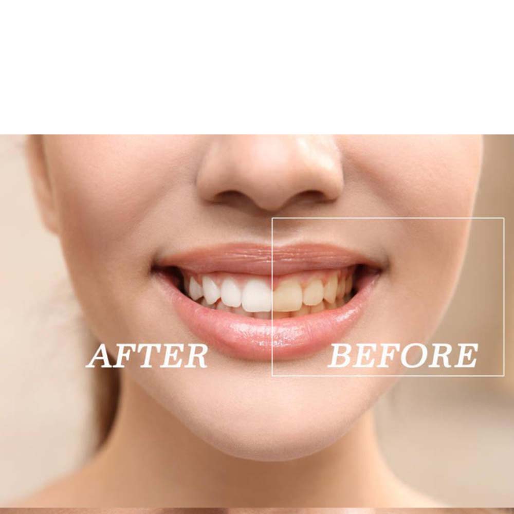 Topkwaliteit Peroxide Tanden W - Teeth Whitening Light Kit recensie en prijs