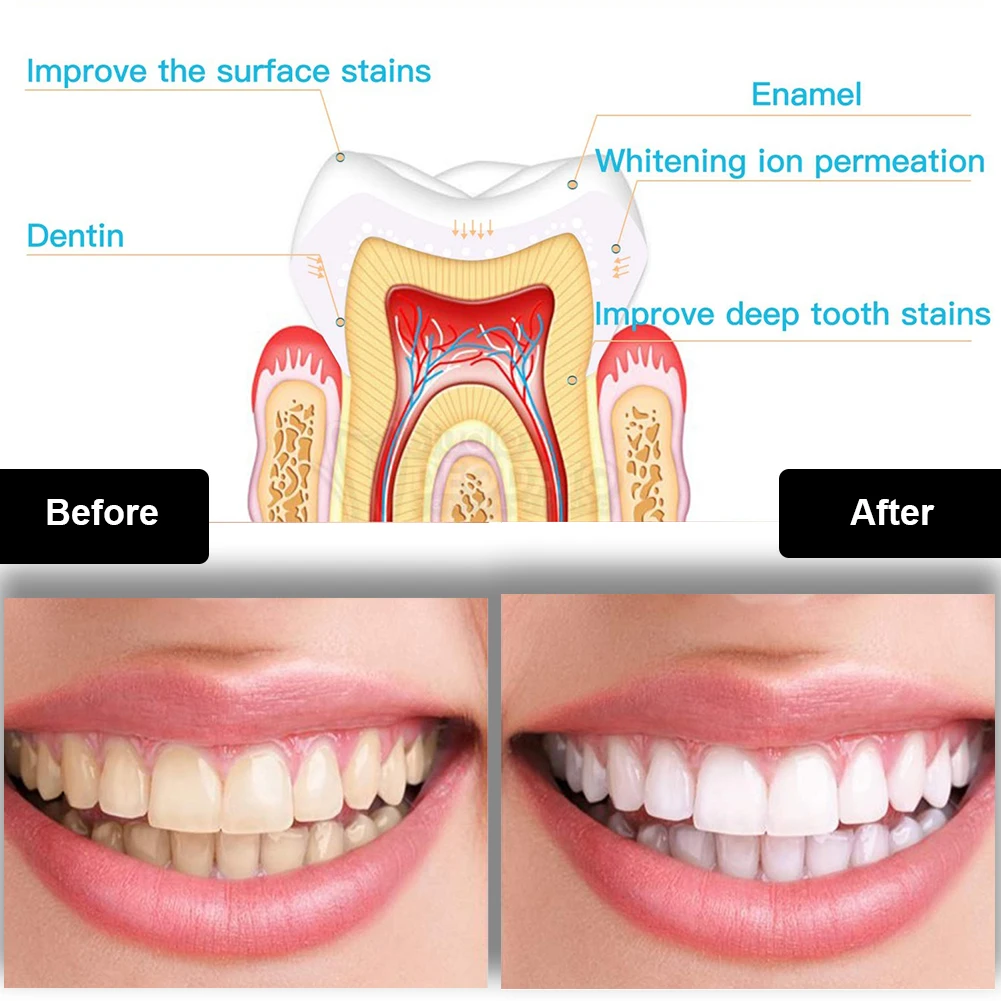Tandheelkundige Tanden Whiteni - Teeth Whitening Light Kit recensie en prijs