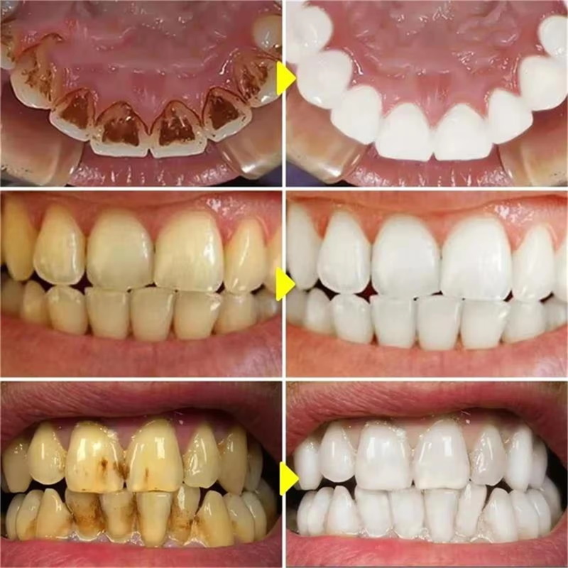 V34 Tanden Whitening Pen Tandp - Whitening Pen Bleach recensie en prijs