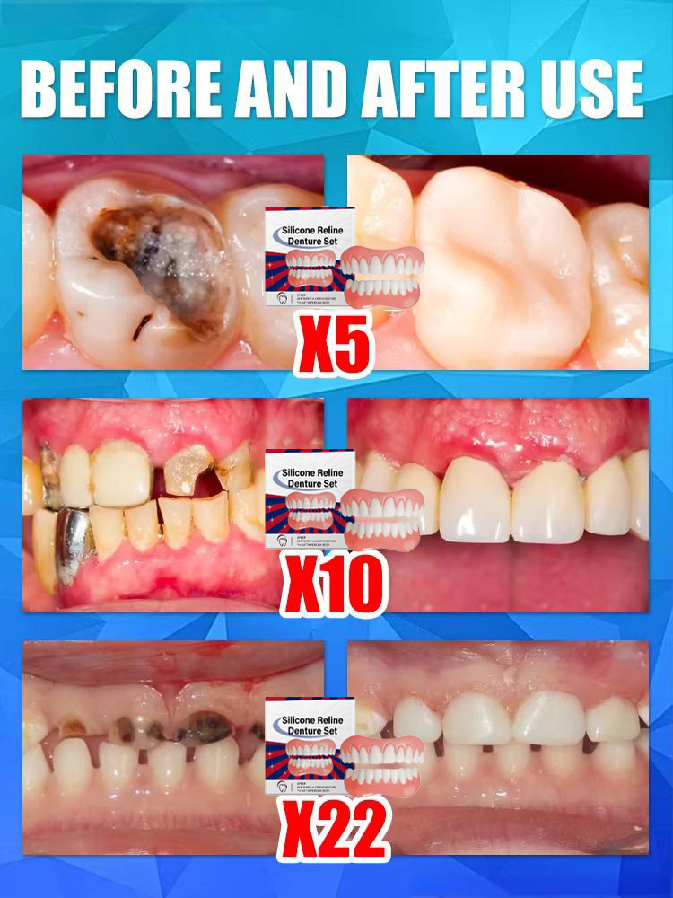 Valse tanden Siliconen bovenst - Teeth Whitening For Braces recensie en prijs