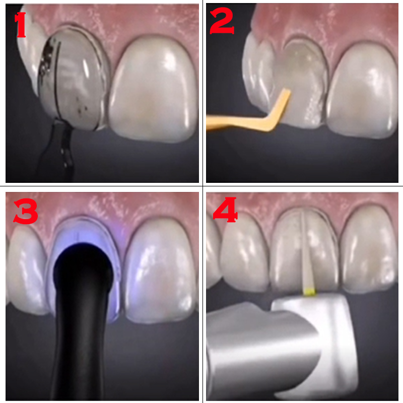 32-delige tandenprothese malse - Teeth Whitening Light Kit recensie en prijs
